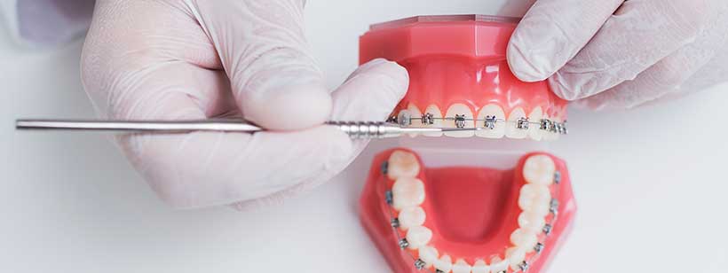 How do traditional braces really work?