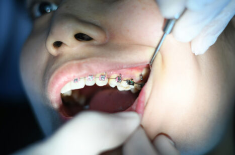 Understanding the Impact of Wisdom Teeth on Braces and Orthodontic Work